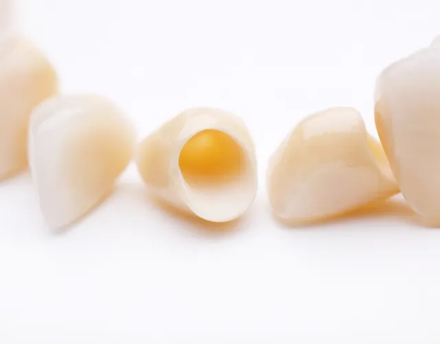 セラミック治療のイメージ