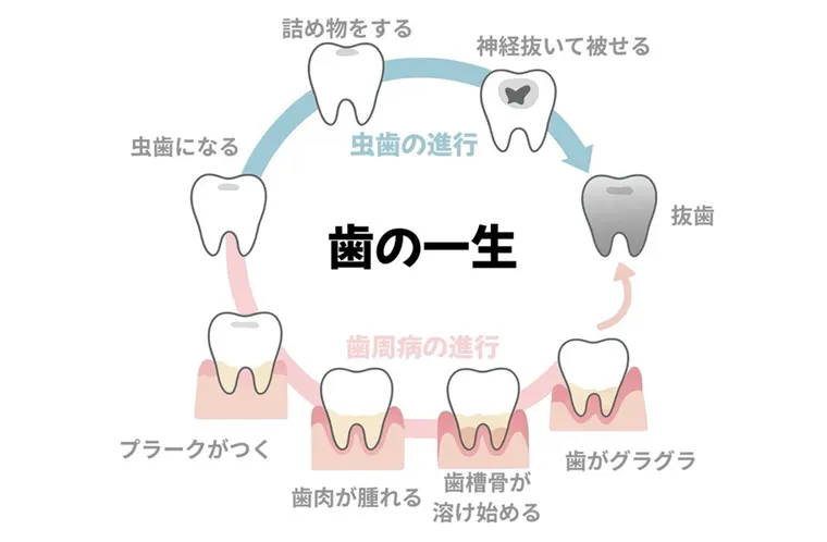 歯の一生（治療の繰り返しのイメージ図）