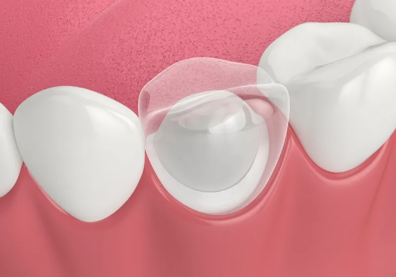 セラミック治療の流れ3 仮歯の装着