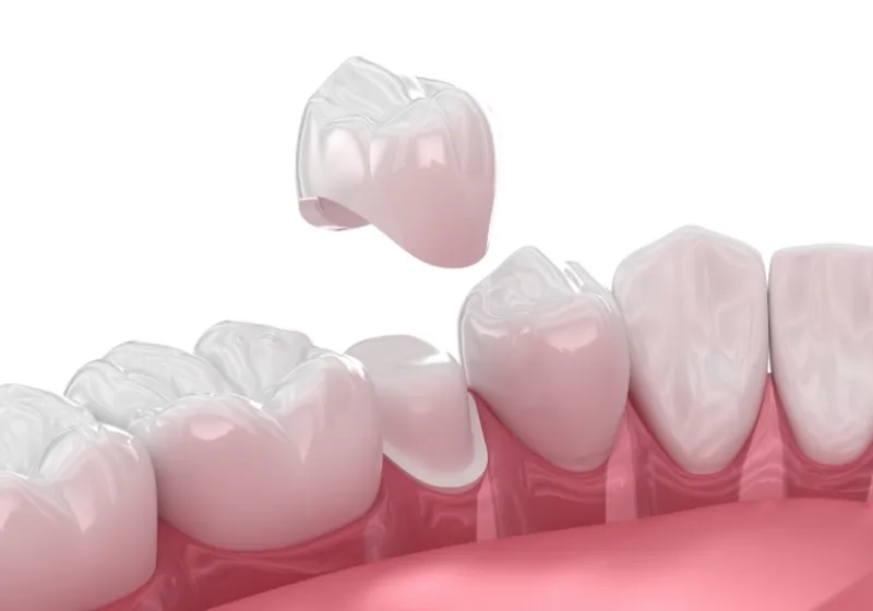 セラミック治療の流れ4 補綴物の装着