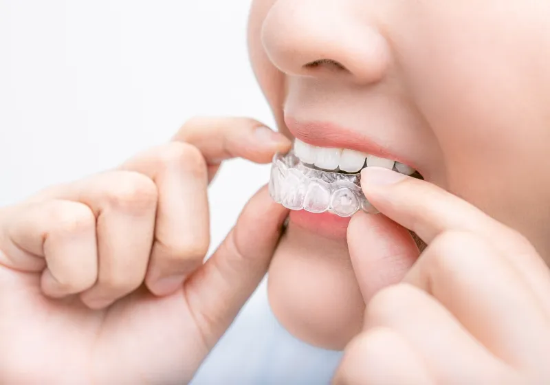 ホームホワイトニングの流れ4 施術の開始