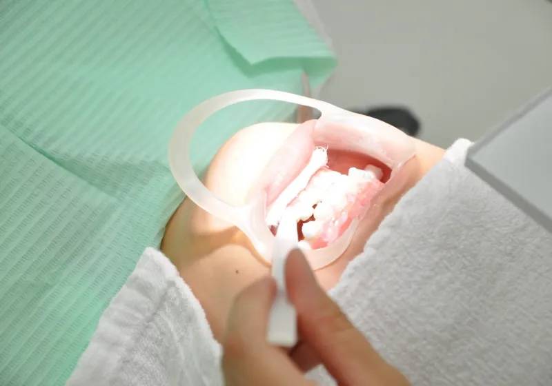 オフィスホワイトニングの流れ3 施術開始