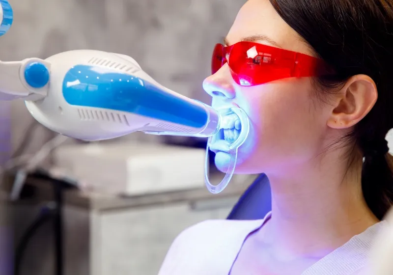 オフィスホワイトニングの流れ4 光の照射