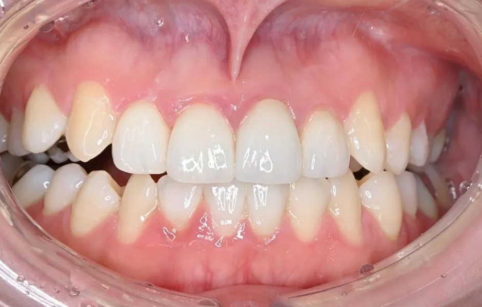 セラミック治療後