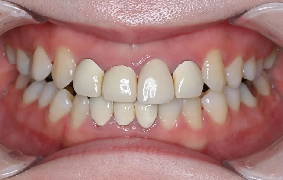 セラミック治療前