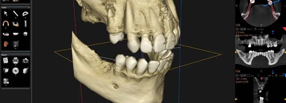 埋入の精度を高め痛みを抑えたインプラント治療