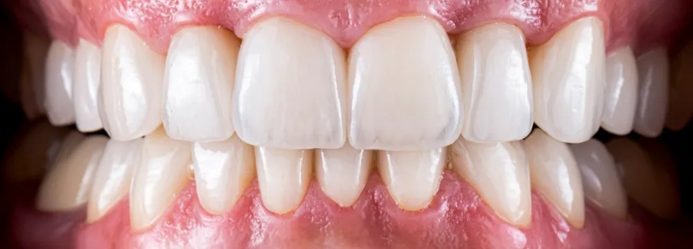 お口全体の機能と審美を再構築するフルオーダーメイドの包括的歯科治療画像