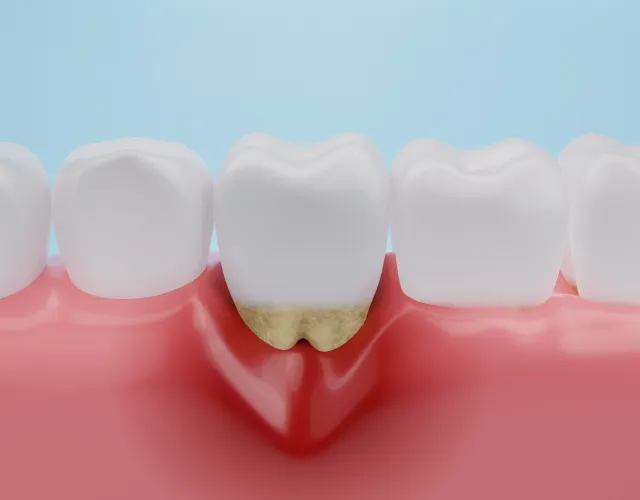 歯周病治療画像