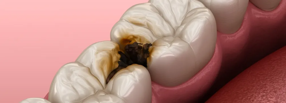 虫歯治療の画像