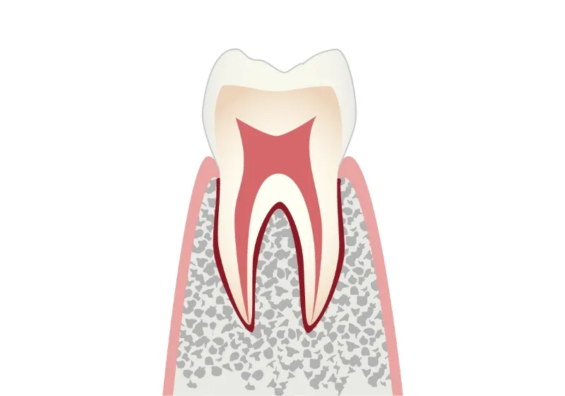 虫歯の進行段階 C0 初期の虫歯