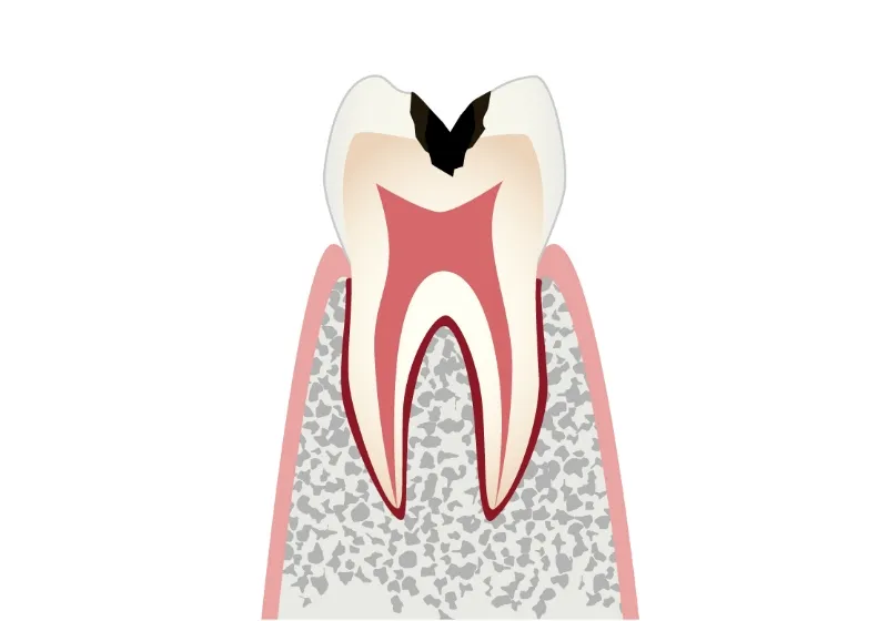 虫歯の進行段階 C2 象牙質の虫歯