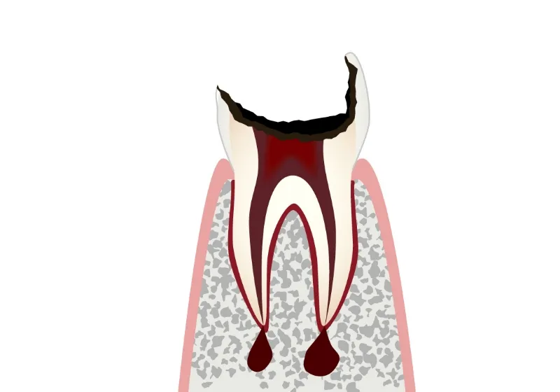 虫歯の進行段階 C4 歯根だけになった虫歯