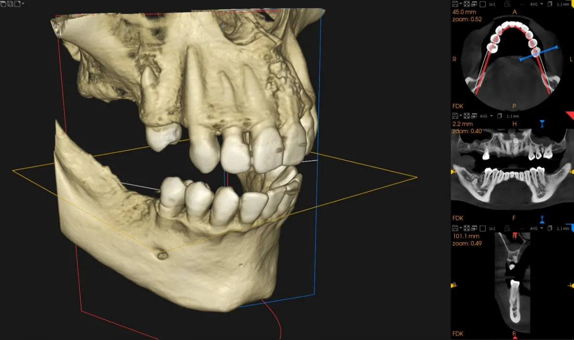 埋入の精度を高め痛みを抑えたインプラント治療 02