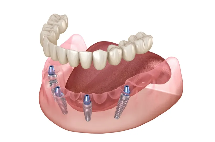 オールオン4・6の画像
