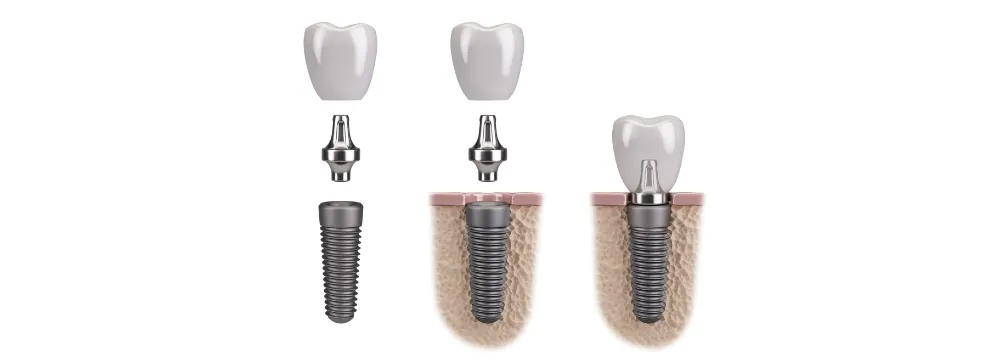 インプラント治療の仕組みのイメージ