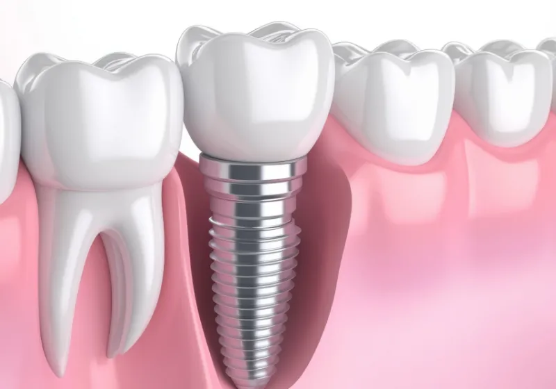 人工歯の装着・噛み合わせ調整の画像