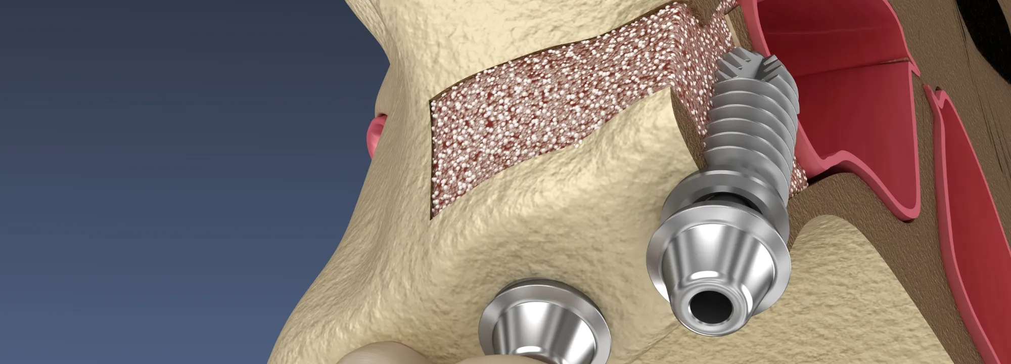 骨造成治療の画像
