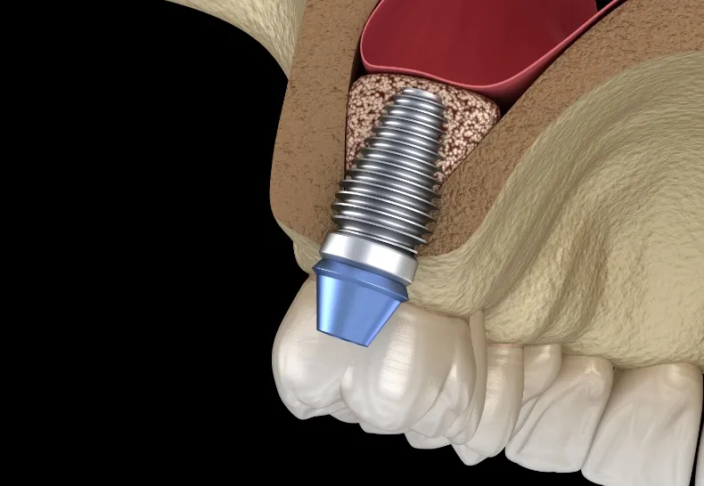 ソケットリフトの画像