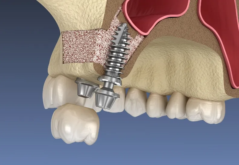 サイナスリフトの画像