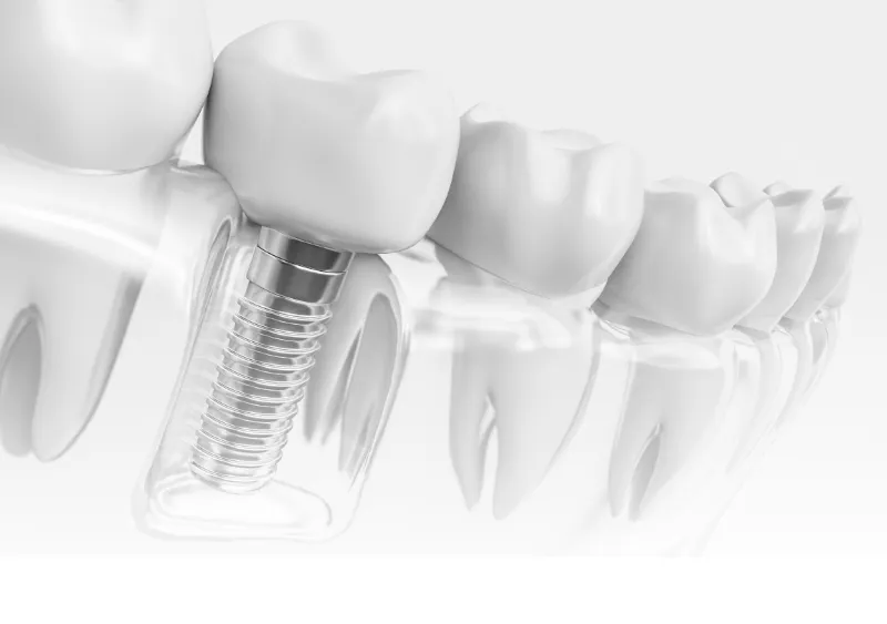 インプラント治療の不安や疑問、「インプラント無料相談」で解決しませんか?