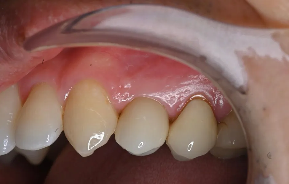 インプラント治療後