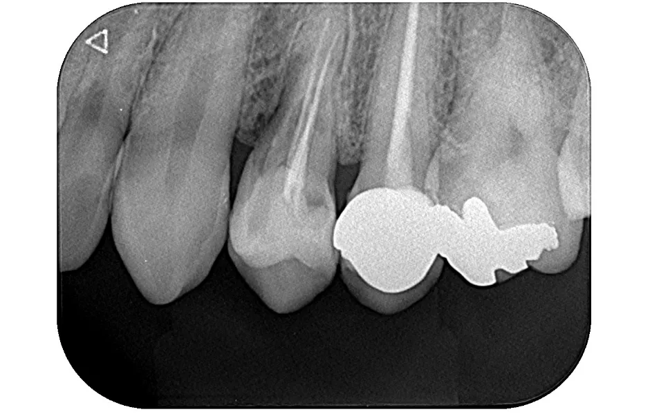 インプラント治療後