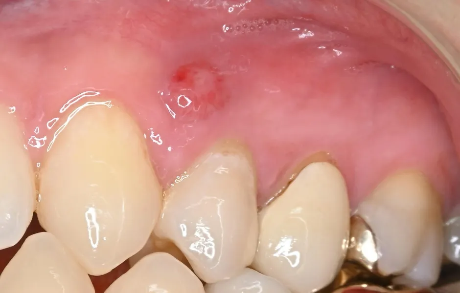 インプラント治療前