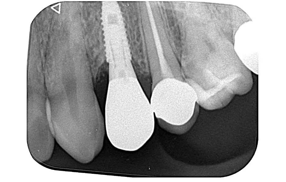 インプラント治療前