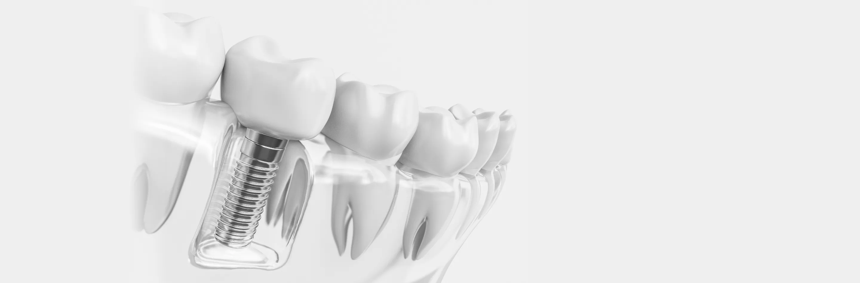 インプラント治療のキービジュアル