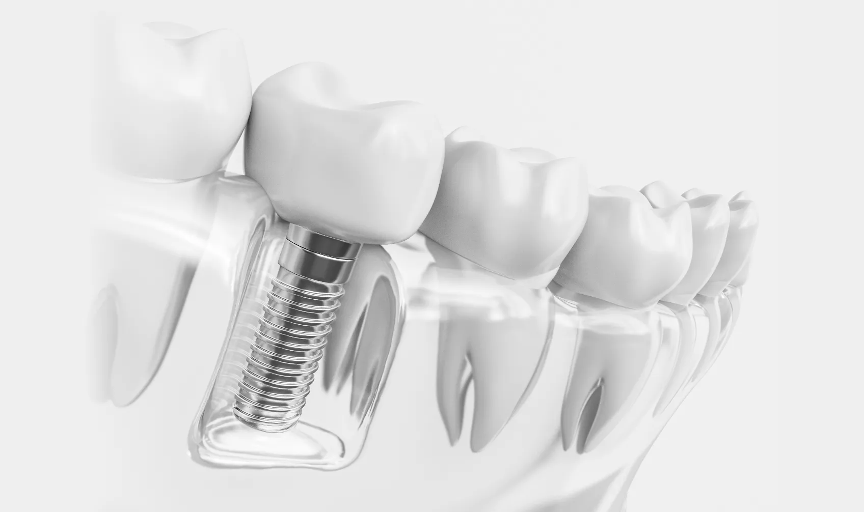 インプラント治療のキービジュアル