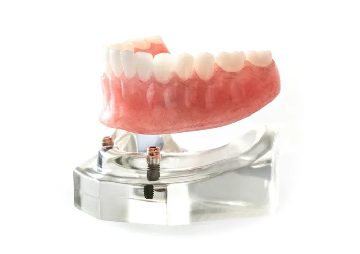 インプラントオーバーデンチャー