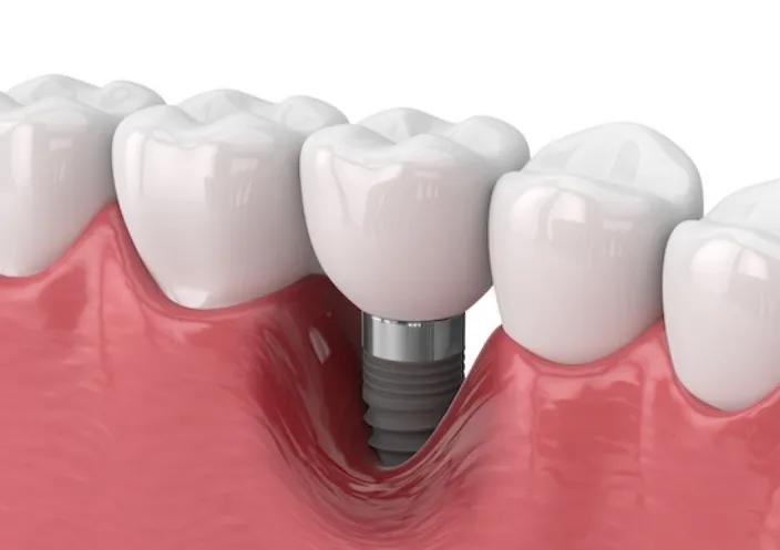 インプラントリペア（再治療）