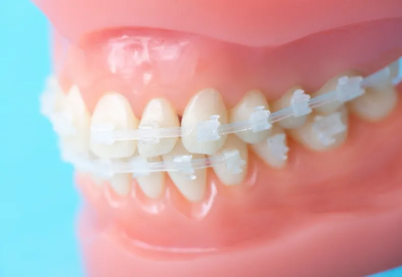 ワイヤー矯正のイメージ