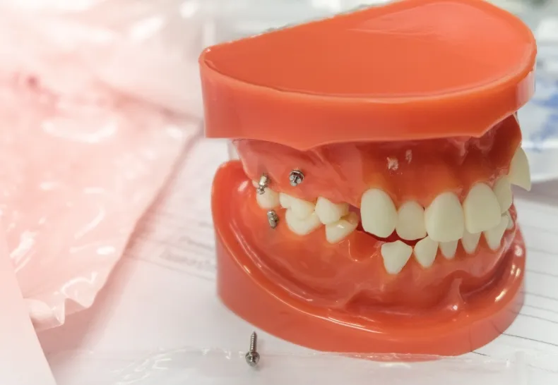 歯科矯正用アンカースクリューのイメージ