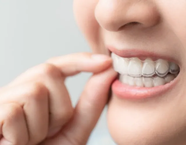 マウスピース型矯正装置の特長1 透明で装着しても目立たない