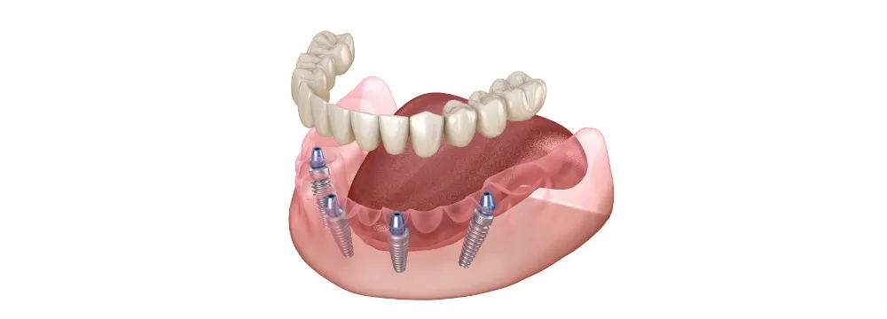 オールオン4・6のイメージ