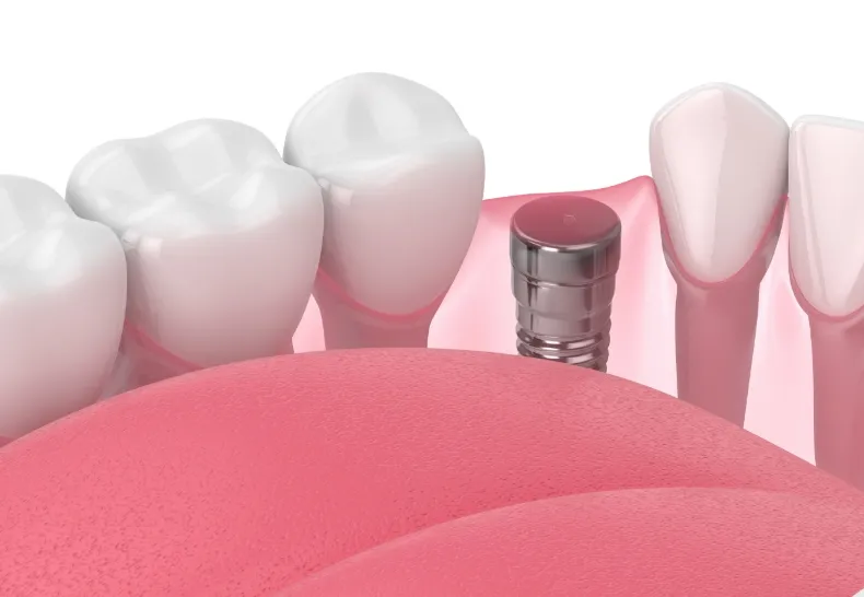 治療の流れ2 インプラントを埋め込む