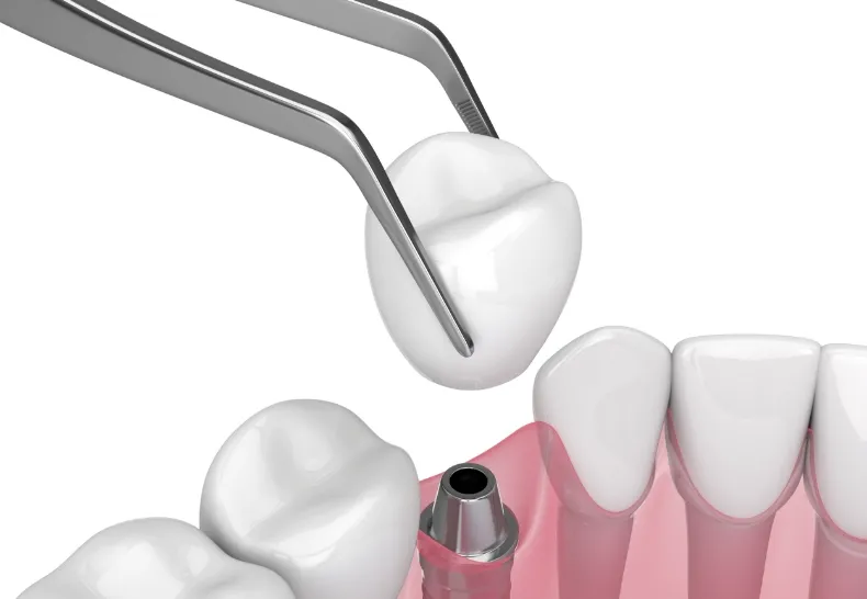 治療の流れ4 入れ歯人工歯の作製