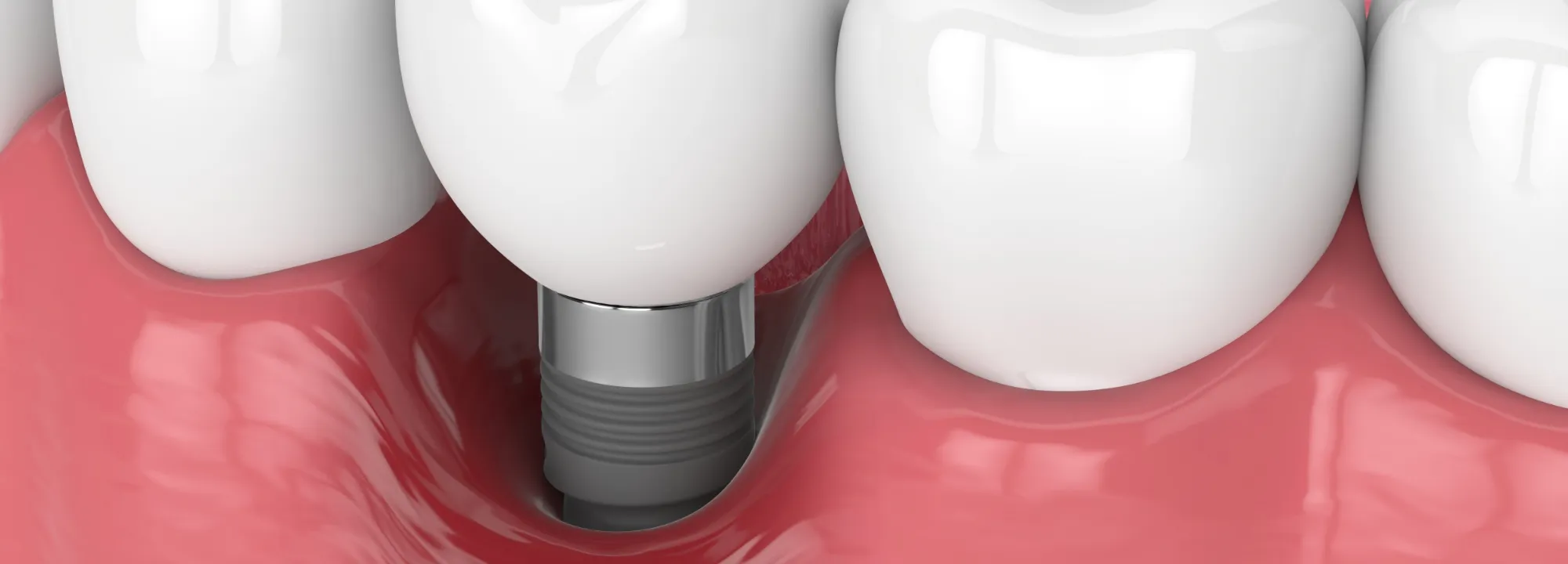 インプラントリペアのイメージ