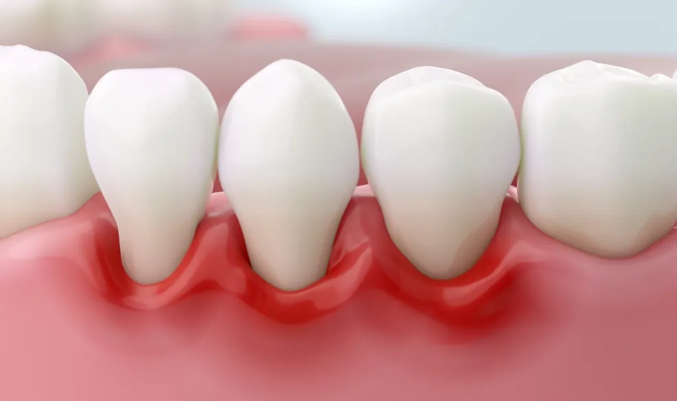 インプラント周囲炎とインプラント周囲粘膜炎の関係のイメージ