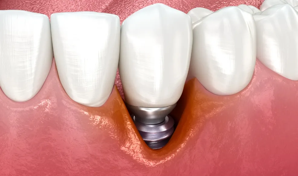 インプラント周囲炎の進行のイメージ