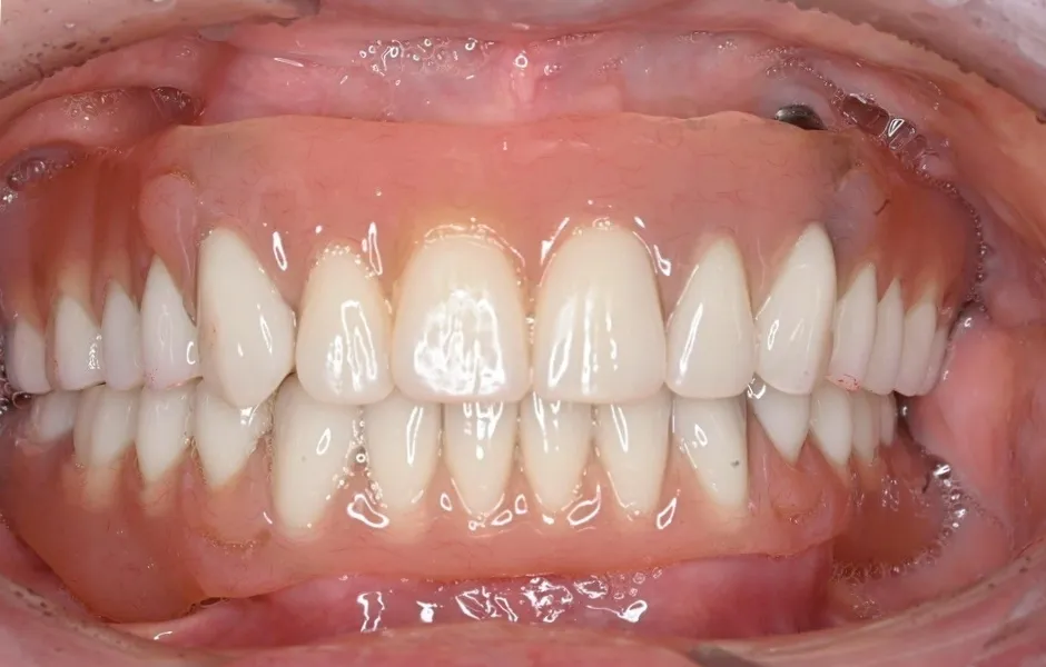 インプラントオーバーデンチャー後