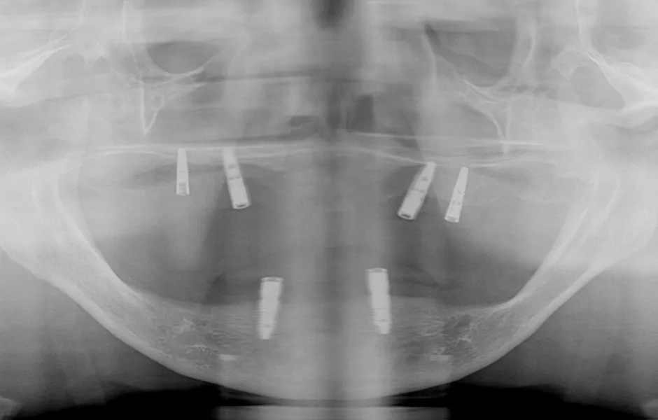 インプラントオーバーデンチャー後