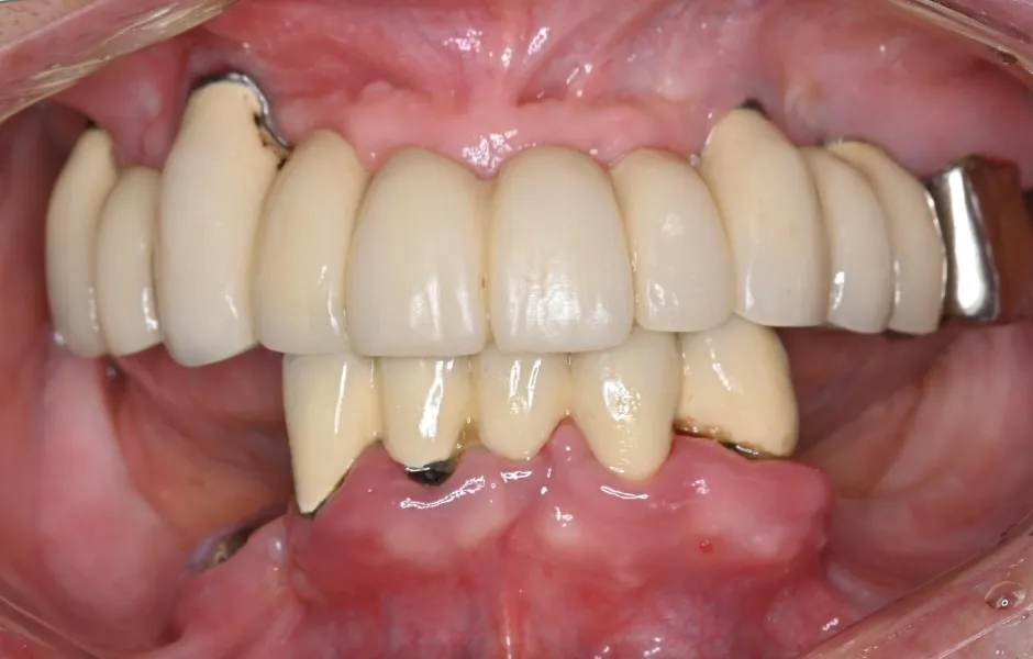 インプラントオーバーデンチャー前