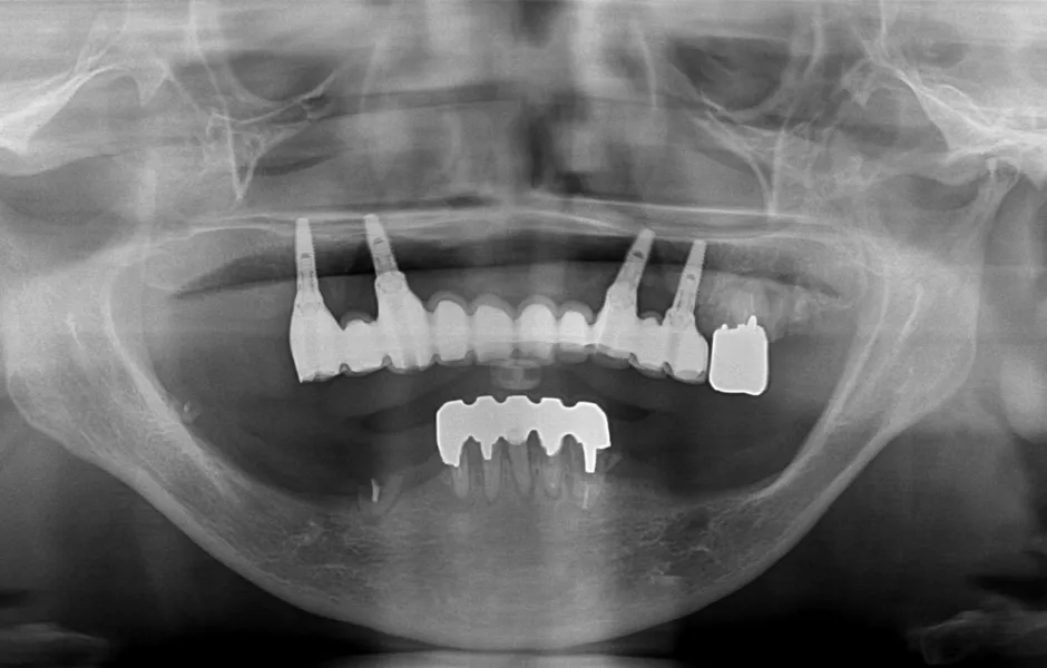 インプラントオーバーデンチャー前