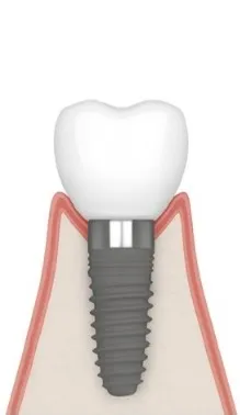 インプラント周囲炎の進行のイメージ
