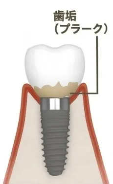 インプラント周囲炎の進行のイメージ