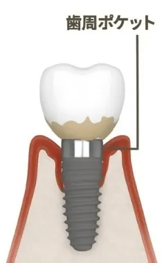 インプラント周囲炎の進行のイメージ