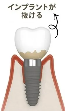 インプラント周囲炎の進行のイメージ