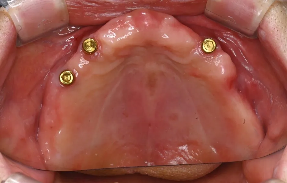 治療前のインプラントオーバーデンチャーのイメージ